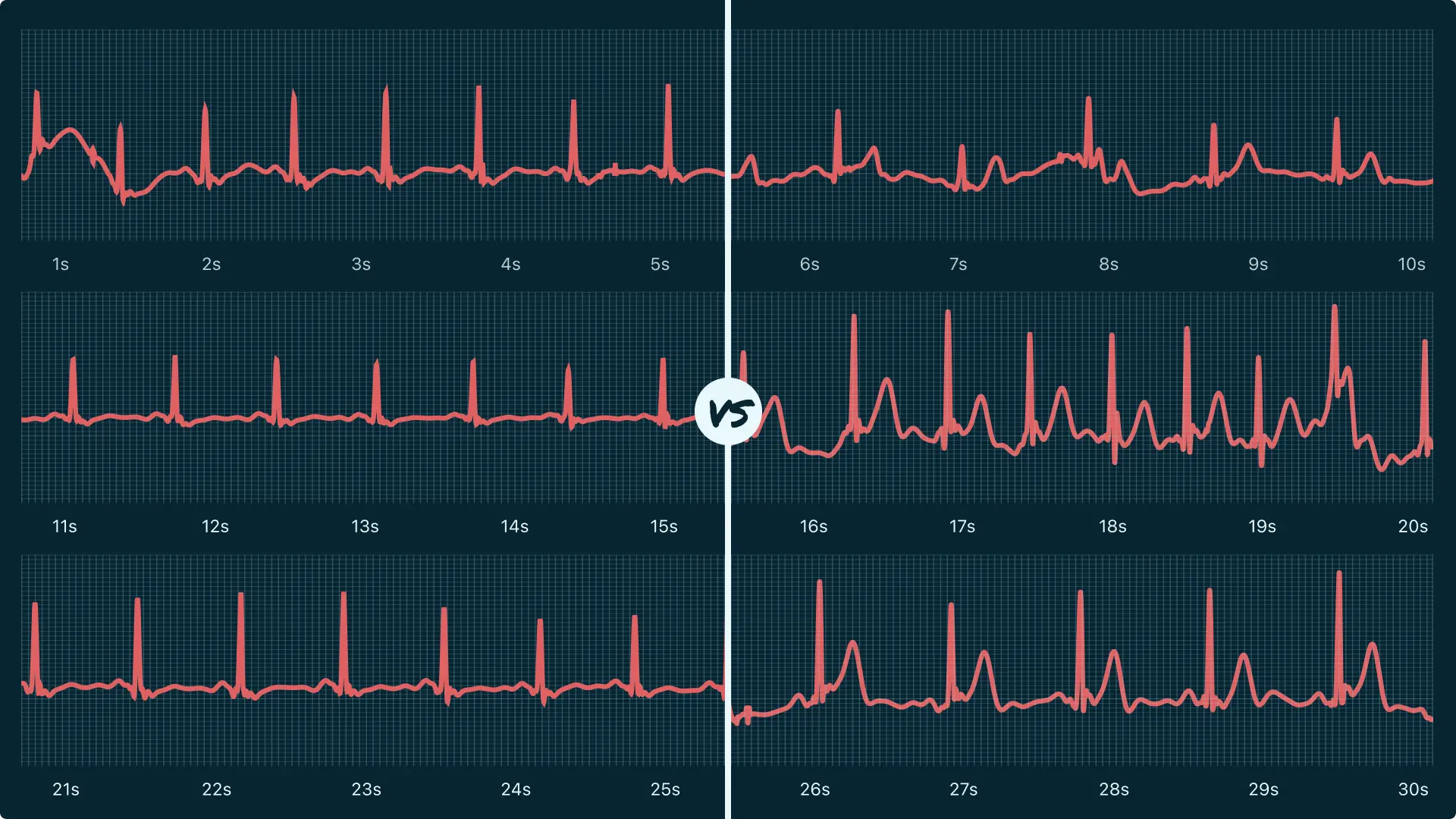 Sinus Arrhythmia Vs. Atrial Fibrillation on Your Watch ECG Qaly